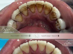 صورة توضيحية لنتائج تقنية Air Flow قي مركز طبي